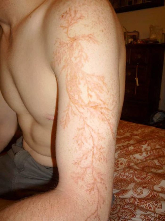 Scars-After-Surviving-Lightning-Strike-Lichtenberg-Figures-Photos-1-5b6d30a7bab41__700