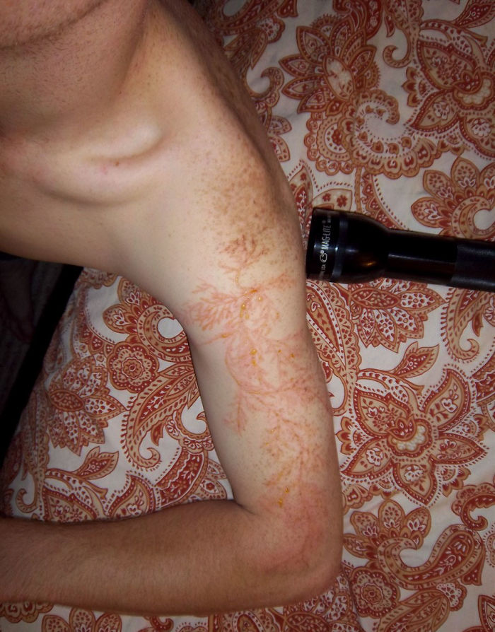 Scars-After-Surviving-Lightning-Strike-Lichtenberg-Figures-Photos-11-5b6d30e490d95__700