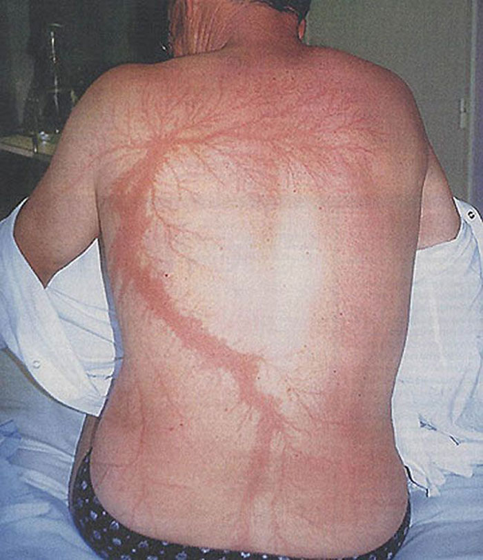 Scars-After-Surviving-Lightning-Strike-Lichtenberg-Figures-Photos-17-5b6d30af76710__700