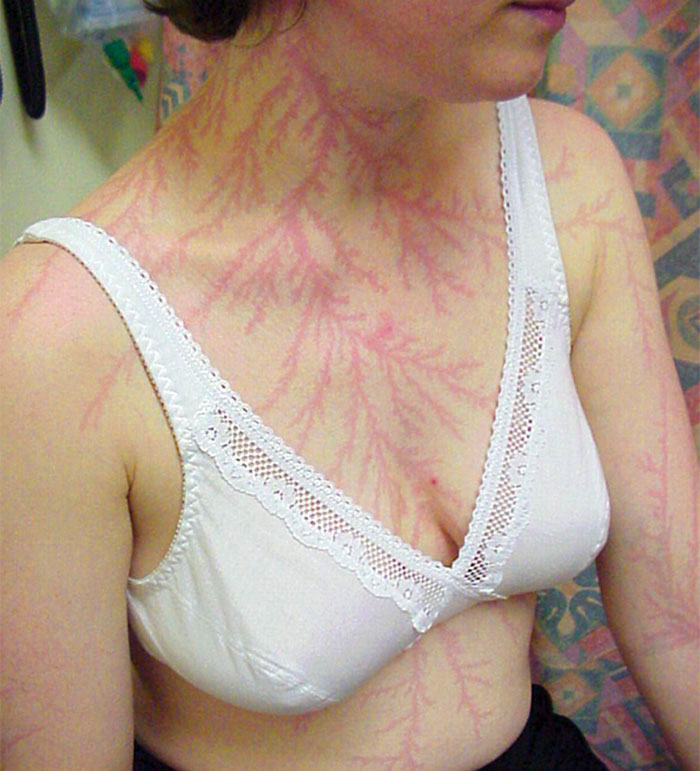 Scars-After-Surviving-Lightning-Strike-Lichtenberg-Figures-Photos-18