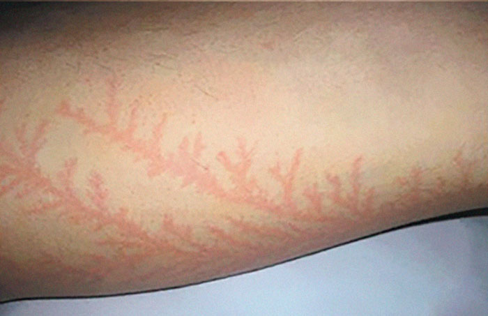 Scars-After-Surviving-Lightning-Strike-Lichtenberg-Figures-Photos-3-5b6d321fb308f__700