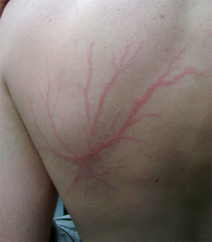 Scars-After-Surviving-Lightning-Strike-Lichtenberg-Figures-Photos-5-5b6d30da68900__700