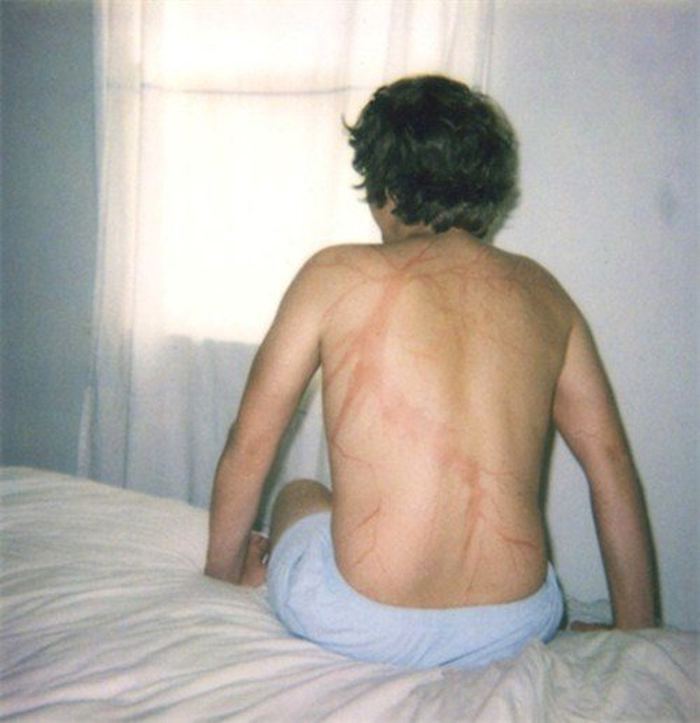 Scars-After-Surviving-Lightning-Strike-Lichtenberg-Figures-Photos-8-5b6d30dfb628a__700