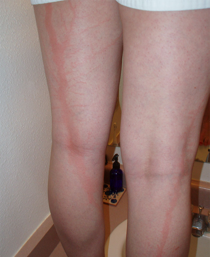 scars-after-surviving-lightning-strike-lichtenberg-figures-photos-5b6d3b9c1db61__700