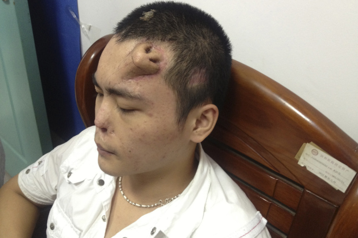 A new nose, grown by surgeons on Xiaolian’s forehead, is pictured before being transplanted to replace the original nose, which is infected and deformed, at a hospital in Fuzhou