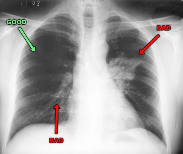 Pneumonia-X-rays-Pictures-1