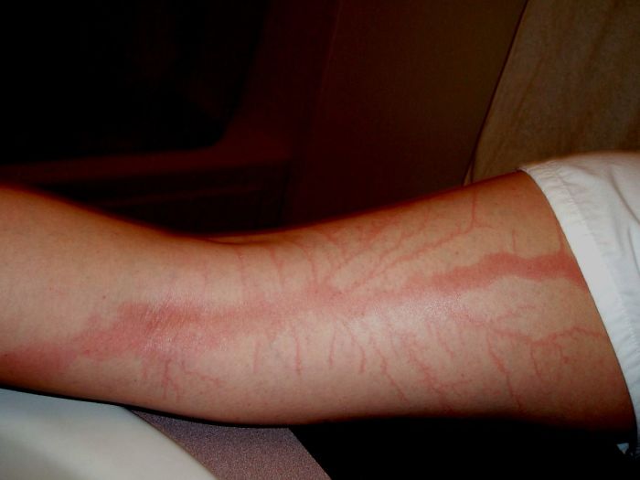 Scars-After-Surviving-Lightning-Strike-Lichtenberg-Figures-Photos-4-5b6d30d915d3d__700